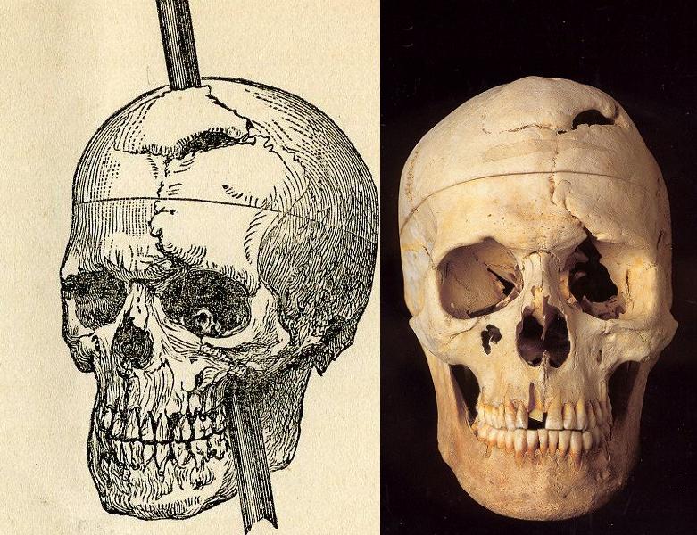 Il cranio di Phineas Gage